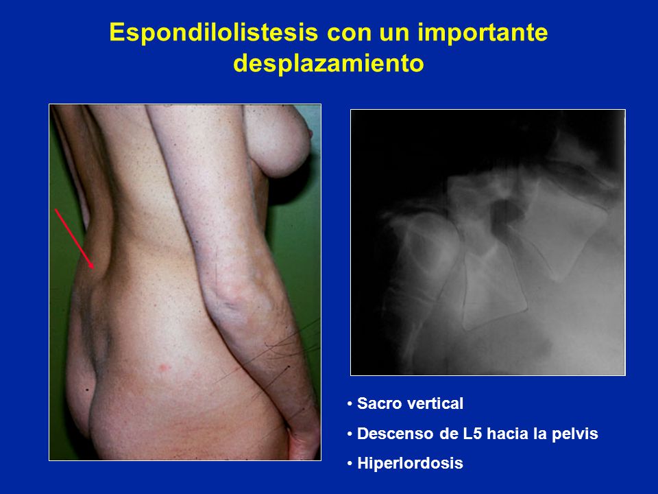 espondilolistesis